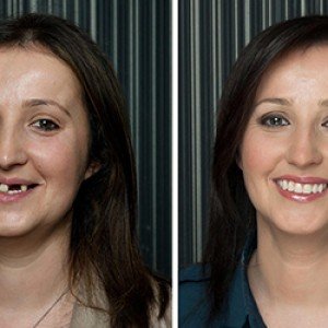 Dental-Implants-1