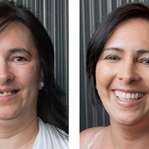Dental-Implants-2