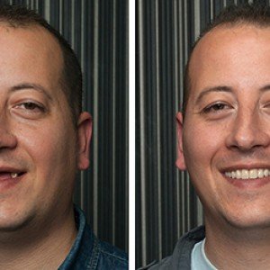 Dental-Implants-5