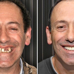 Dental-Implants-6