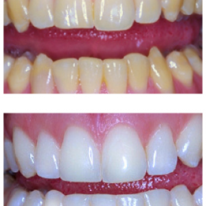Teeth Whitening in Preston, our number one Cosmetic Dental Treatment