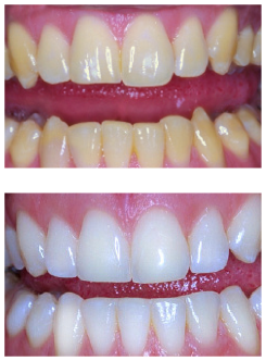 Teeth Whitening in Preston, our number one Cosmetic Dental Treatment