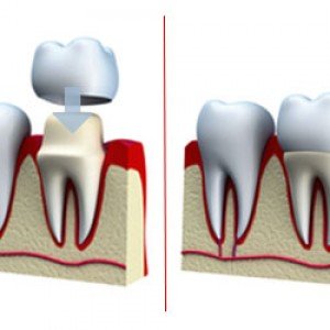 Dental Crowns